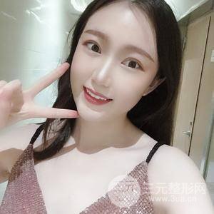 切開雙眼皮+上瞼下垂矯正術(shù)前術(shù)后果對(duì)比圖