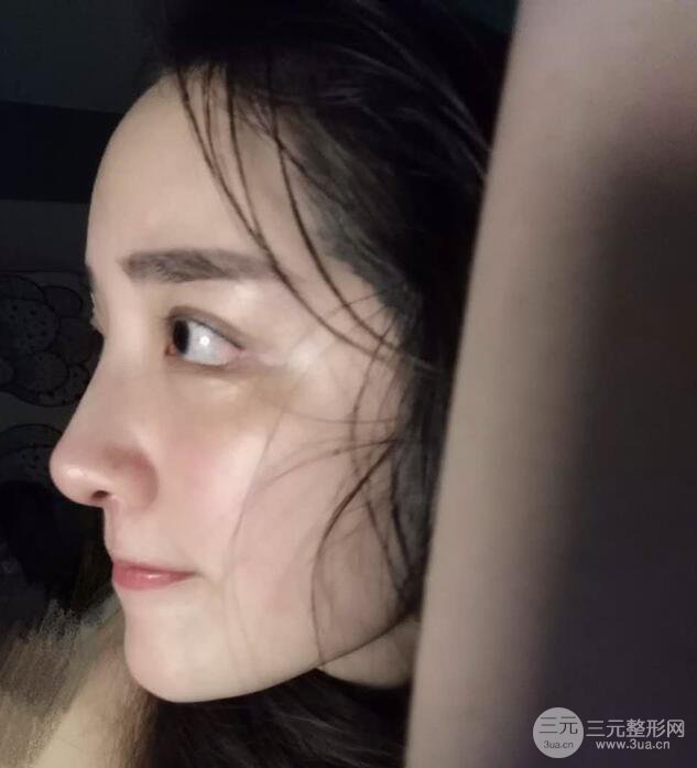 東莞寶格麗韋文奇隆鼻整形果圖分享，對比曝光