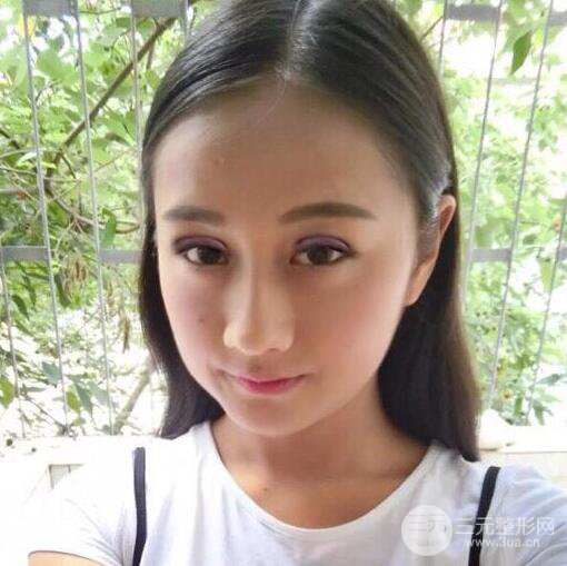 威高梨花醫(yī)療美容金成鎬全切雙眼皮+開眼角術(shù)后恢復(fù)記錄