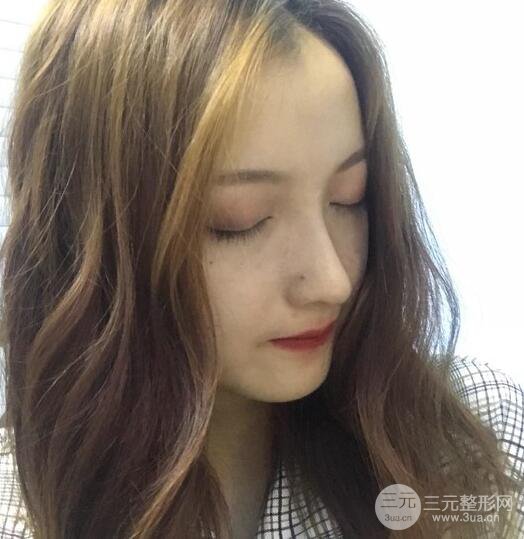 隆鼻整形多久恢復(fù)自然，模特公布隆鼻整形恢復(fù)記錄附照片