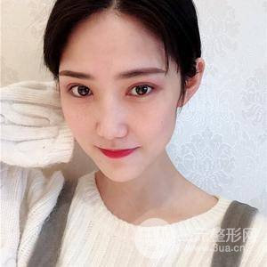 雙眼皮三個(gè)月果恢復(fù)圖