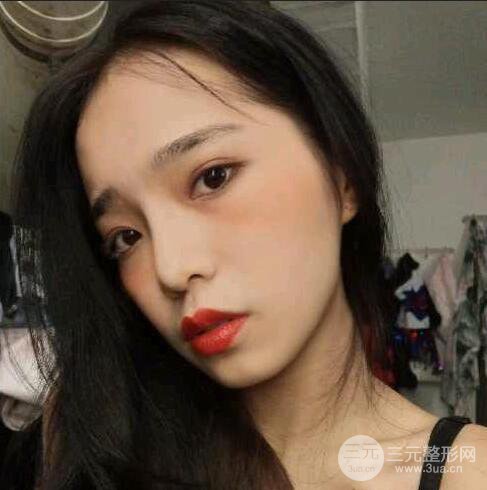 隆鼻整形術(shù)前術(shù)后對(duì)比照曝光，附經(jīng)驗(yàn)分享及心得體會(huì)