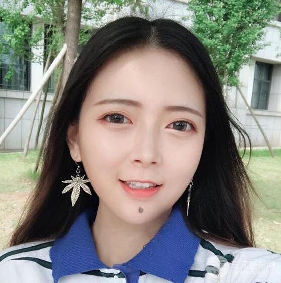 揚州艾菲斯黃嬋雙眼皮多項整形整形果真人反饋