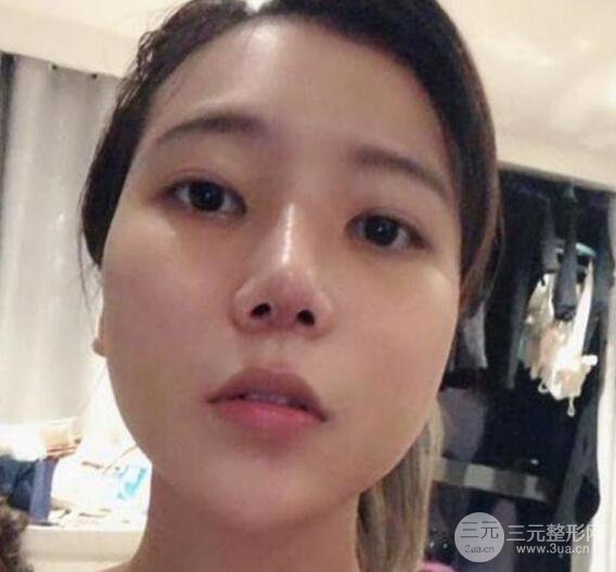 隆鼻整形手術(shù)三個(gè)月后真人果圖