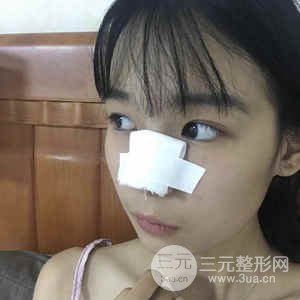 肋軟骨隆鼻果對(duì)比圖