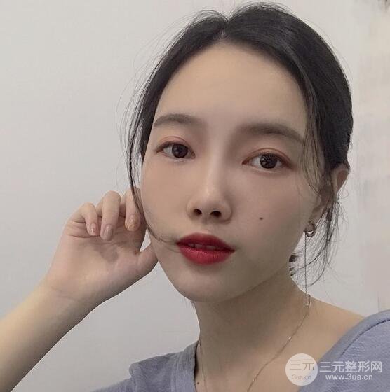 上海華美李健自體脂肪詳細部填充果圖，少女臉經(jīng)久不衰的秘密在這里