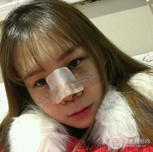 隆鼻整形三個月恢復(fù)真實圖片，做完土妹子變網(wǎng)紅辣