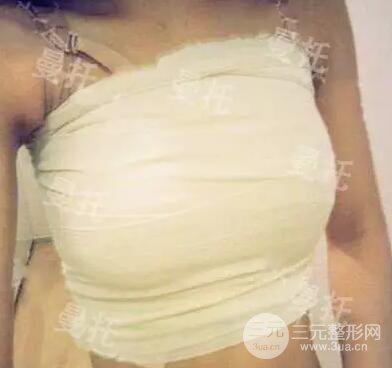 分享我的曼托隆胸圖片