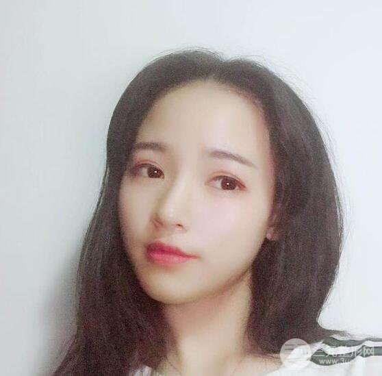 銀川崔大夫博士麗醫(yī)療美容朱杰膨體隆鼻果反饋