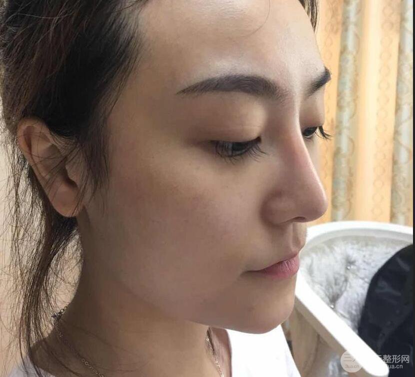 做了自體脂肪填充全臉，別人都以為我老公較為有錢