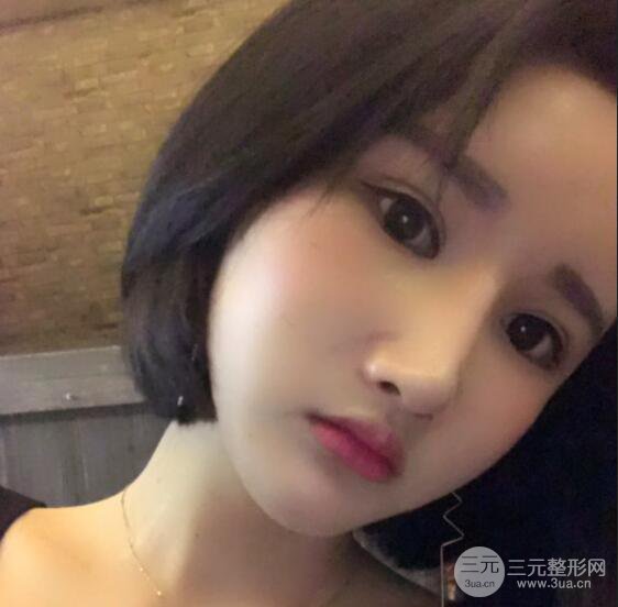 去下頜角+顴骨內(nèi)推手術(shù)三個月記錄，看大臉妹如何逆襲