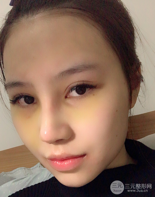 自體脂肪填充面部案例,神奇的變臉術(shù)