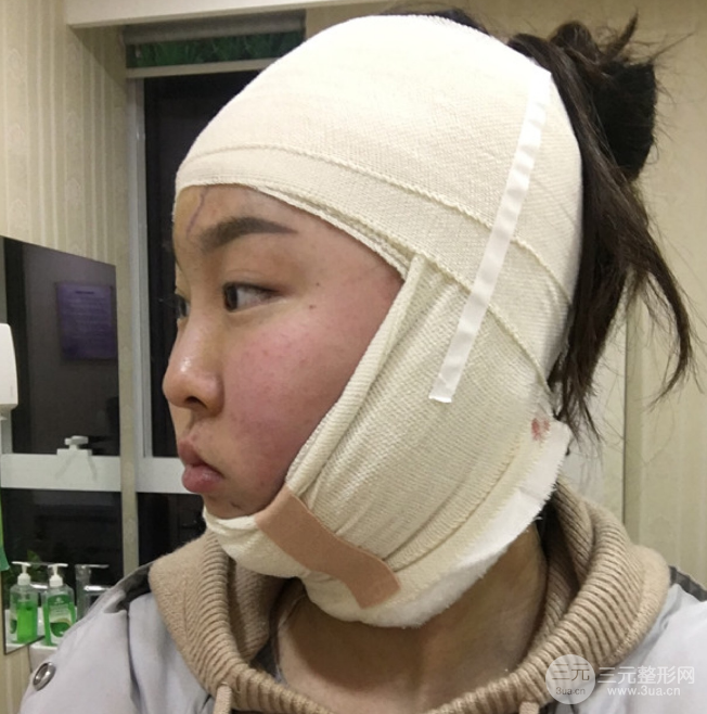 面部光纖溶脂三個月恢復記錄，妹子終于擺脫大臉盤子辣