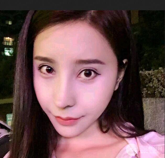 青島海倫整形朱洪濤肋軟骨隆鼻恢復(fù)記錄