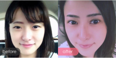 雙眼皮多少錢？雙眼皮整形手術(shù)前后對比圖