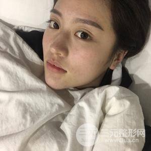 面部吸脂100天恢復(fù)果對(duì)比圖