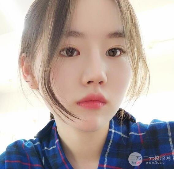 上海華美醫(yī)療美容李庭勛膨體隆鼻怎么樣？果對比圖