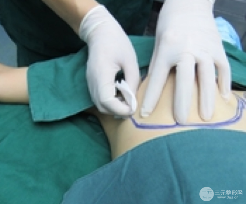 自體脂肪隆胸恢復(fù)圖曝光，見(jiàn)證從A到C的蛻變