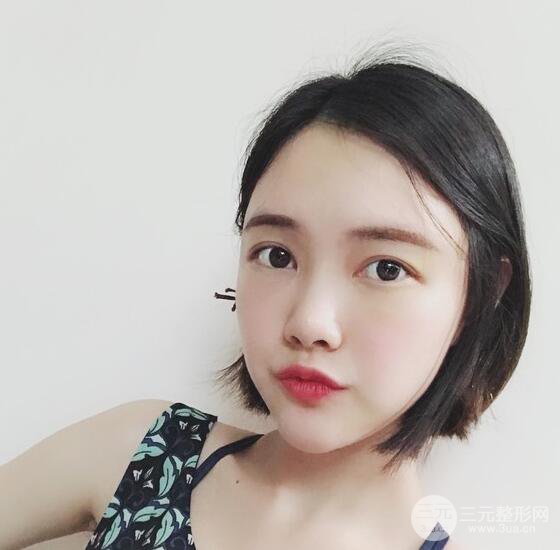 上海華美李健自體脂肪詳細部填充果圖，少女臉經(jīng)久不衰的秘密在這里