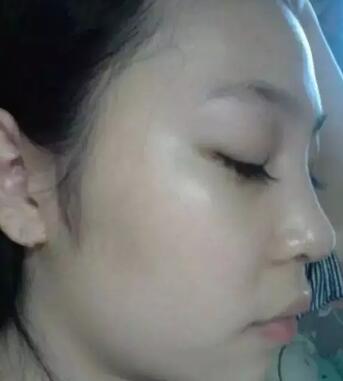 我的假體隆鼻恢復(fù)過(guò)程,有圖有真相哦~