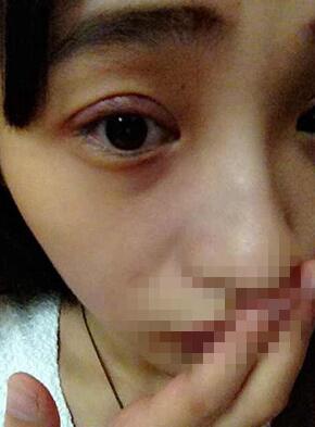 雙眼皮恢復(fù)過程經(jīng)歷