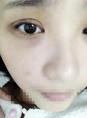 雙眼皮恢復(fù)過程經(jīng)歷