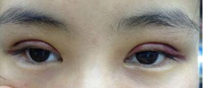 全切雙眼皮十天啦~來(lái)看看我的果