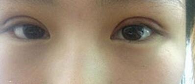 全切雙眼皮十天啦~來(lái)看看我的果