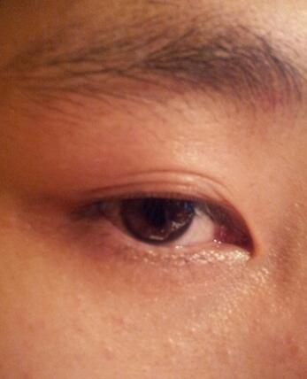 八大處靳小雷埋線雙眼皮一個多月了，果很好哦~~~