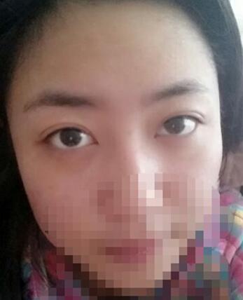 八大處靳小雷埋線雙眼皮一個多月了，果很好哦~~~