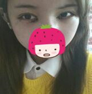 一起來(lái)評(píng)價(jià)一下重慶愛思特盧剛醫(yī)生做的切開雙眼皮吧