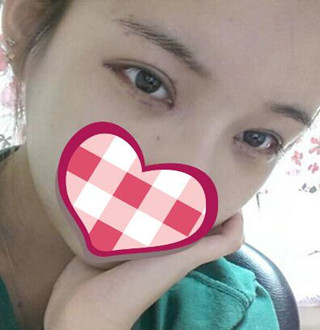 一起來(lái)評(píng)價(jià)一下重慶愛思特盧剛醫(yī)生做的切開雙眼皮吧