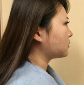 董薇薇醫(yī)師為我做的玻尿酸墊下巴術(shù)前術(shù)后對比照