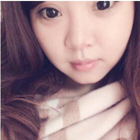 董薇薇醫(yī)師為我做的玻尿酸墊下巴術(shù)前術(shù)后對比照