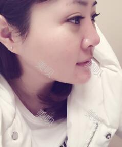 董薇薇醫(yī)師為我做的玻尿酸墊下巴術(shù)前術(shù)后對比照