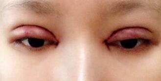 全切雙眼皮+去皮去脂+開(kāi)眼角一個(gè)月了~