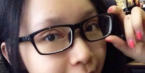 全切雙眼皮+去皮去脂+開(kāi)眼角一個(gè)月了~