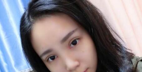 全切雙眼皮+去皮去脂+開(kāi)眼角一個(gè)月了~