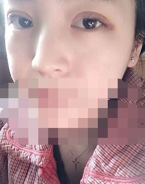 做埋線雙眼皮一周啦~果滿滿的！