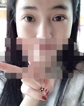 做埋線雙眼皮一周啦~果滿滿的！