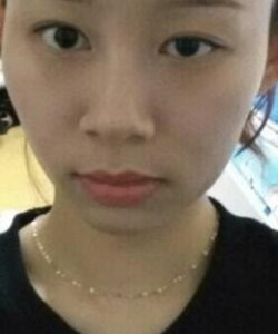 去北京301醫(yī)院整形美容科做了顴骨內(nèi)推大家快來圍觀啦