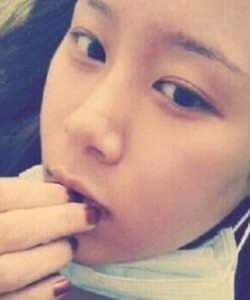 去北京301醫(yī)院整形美容科做了顴骨內(nèi)推大家快來圍觀啦