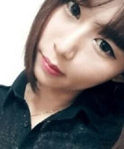 去北京301醫(yī)院整形美容科做了顴骨內(nèi)推大家快來圍觀啦