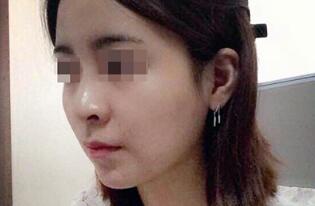 下頜骨削骨瘦臉整形手術(shù)真實(shí)案例多圖對比分享