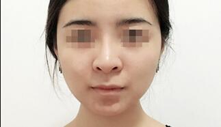 下頜角削骨瘦臉手術(shù)很成功