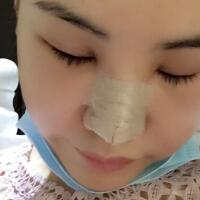 硅膠假體隆鼻和鼻翼縮小隆鼻整形花費(fèi)15800元