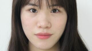 隆鼻整形包括假體隆鼻和鼻翼縮小，費(fèi)用一共為15800元