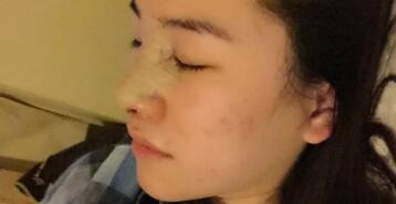 隆鼻整形術(shù)后恢復(fù)圖