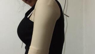 吸脂減肥瘦手臂，甩掉蝴蝶袖告別粗手臂真實(shí)案例分享