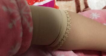 吸脂減肥瘦手臂，甩掉蝴蝶袖告別粗手臂真實(shí)案例分享